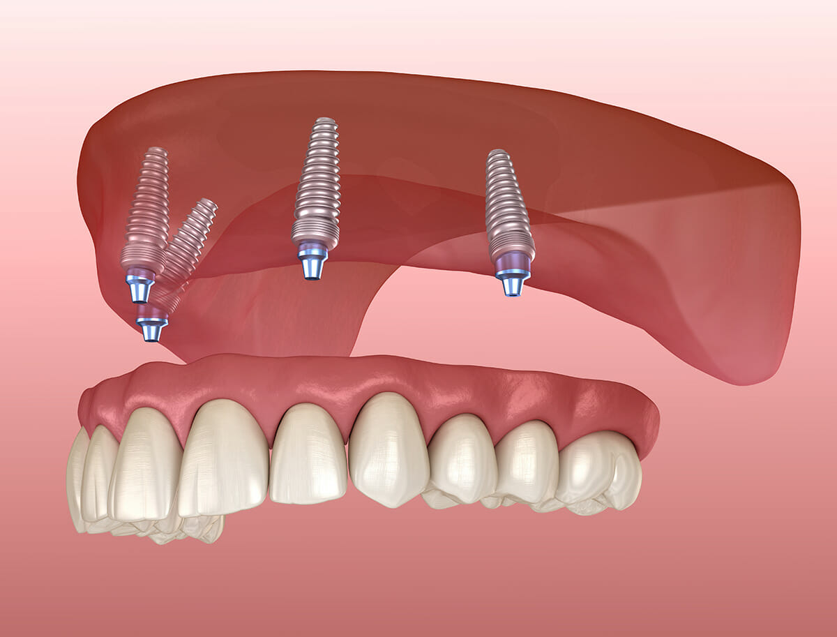All-on-four dental implants graphic