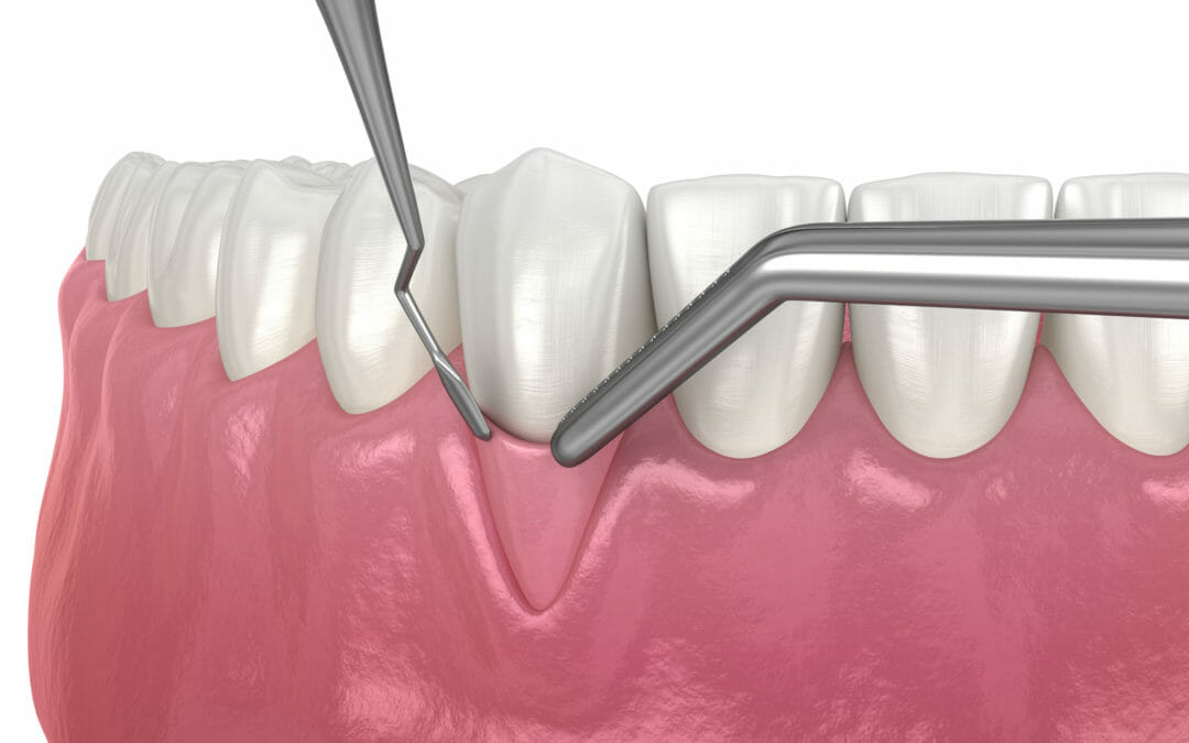Gum Tissue Graft Surgery: What to Expect