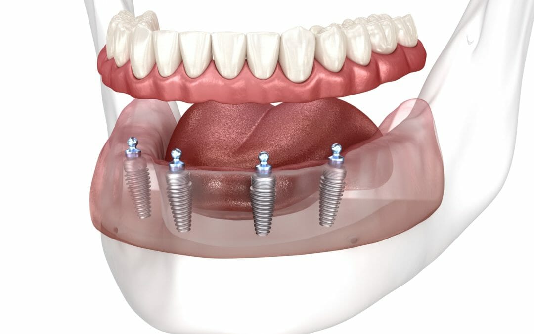 What are the benefits of all-on-four dental implants?