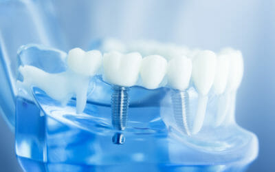 What to expect with dental implants