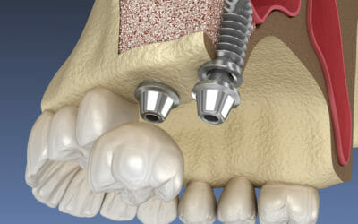 With a Sinus Lift Operation, You Can Boost Your Dental Health